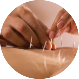 Le premier traitement d’acupuncture Le premier traitement d’acupuncture